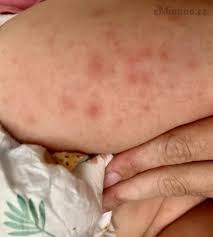 Image result for vyrážka u dětí