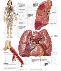 Image result for Cor Pulmonale