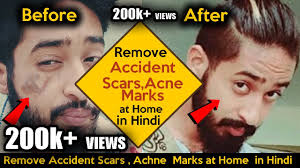 remove accidental or scars marks