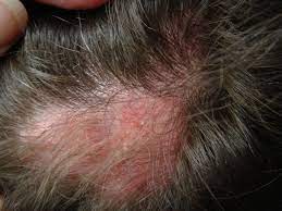 Diskoider Lupus Erythematodes Deximed