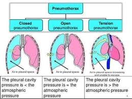It's the most common type of pneumothorax and happens most often in healthy young adults. Types Of Pneumothorax Kanika S Nursing Academy Facebook