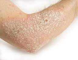 الدليل الكامل لأنواع وعلاج مرض الصدفية psoriasis الجمال نت