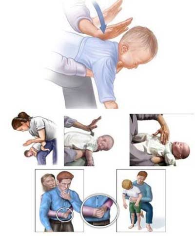 Xử trí đúng cách, kịp thời khi mắc dị vật đường thở