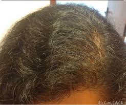 These symptoms can include malabsorption, diarrhea, weakness, fatigue, abdominal pain, joint pain, and weight loss. Our Hair Loss Diet Completely Reverses Hair Thinning And Balding