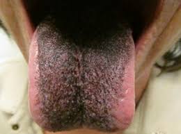 Image result for black hairy tongue symptoms