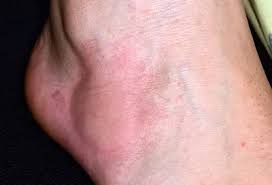 Image result for Fire Ant Sting