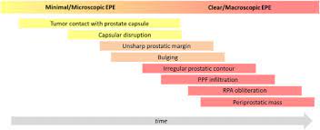 Specifically this lecture will focus on the role in diagnosis, T Staging Of Prostate Cancer Identification Of Useful Signs To Standardize Detection Of Posterolateral Extraprostatic Extension On Prostate Mri Clinical Imaging