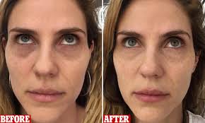 Under eye concealers come in stick, cream, or pot, as well as liquid. Now Women Are Getting Their Dark Circles Tattooed Away With Permanent Concealer Daily Mail Online
