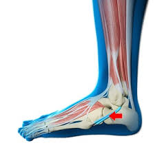 Image result for Ankle Dislocation