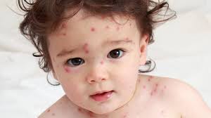 ÐÐ°ÑÑÐ¸Ð½ÐºÐ¸ Ð¿Ð¾ Ð·Ð°Ð¿ÑÐ¾ÑÑ chickenpox