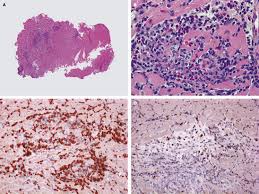 Myocarditis is an inflammatory disease of the myocardium that may present with sudden cardiac death, symptoms mimicking myocardial infarction, heart rhythm and conduction disorders, and heart failure. Eosinophilic Lymphocytic Myocarditis After Smallpox Vaccination The Lancet