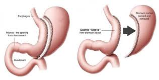 Pin On Gastric Treatment