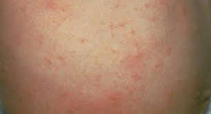 Image result for skin rash similar to scabies