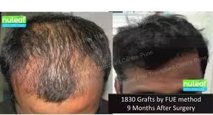 How Does Hair Grow After Hair Transplant Surgery Quora