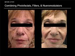 Liquid & Laser Lifts