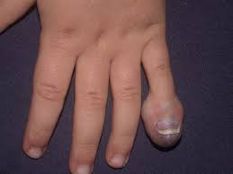 El Tumorleri Istanbul Elcerrahisi