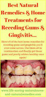 How To Reverse Heal Receding Gums Gingivitis 8 Home Remedies That Work Like A Charm Receding Gums Natural Remedies Gingivitis