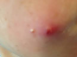 Maybe you would like to learn more about one of these? Molluscum Contagiosum Can You Give My Daughter Some Advice Please Thanks In Advance Patient Talk