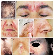 Image result for Seborrheic Dermatitis
