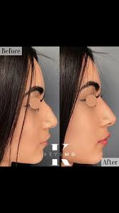 ✨ Small Changes Lead to Great Results ✨ , In this patient, I performed a  non-surgical rhinoplasty and lip augmentation using dermal fillers placed  in just the right areas to enhance her profile. The ...
