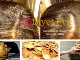 Sac Beyazlamasina Patetes Kabugu Peeling Potatoes Boost Hair Growth Hair