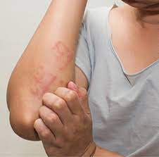 Cara hilangkan gatal di badan. Cara Mudah Hilangkan Alergi Udang