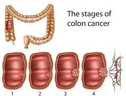 It is also used between hours and minutes in time, between certain elements in medical journal citations, chapter and verse in bible citations, and, in the us, for salutations in business. Colon Cancer Stages Types And Treatments Of The Disease