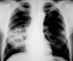 Image result for Lung Abscess