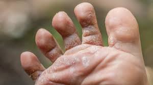 Can hand sanitizer affect a urine test? Ringworm On Foot Symptoms Treatment Prevention