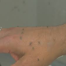 Mosquito saliva contains polypeptides that stimulate mast cells present in the skin. Mosquito Bites Could Lead To Skeeter Syndrome