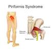 It connects the hip bone (iliac crest) and the bottom of the spine (sacrum) to the upper thigh (iliotibial band and femur). 1