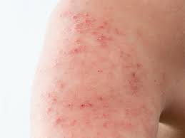 Esta se presenta cuando un virus que ataca las células nerviosas se reactiva después de un tiempo y es de esa manera como se causa la erupción o salpullido. Herpes Zoster La Famosa Culebrilla En La Piel