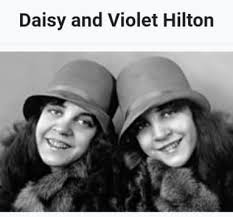 Conjoined twins exploited for profit in England