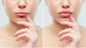 The more you want to plump your pout, the more it'll cost, so you better get. Needleless Lip Fillers Lip Fillers Without Needles Dr Michele Green M D