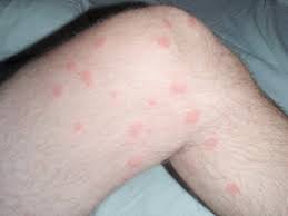 In conclusion as you can see, vinegar is a simple and effective solution for getting rid of fleas. Fast Acting Remedies To Treat Flea Bites Flea Bites Did You Know That A Single Flea Can Bite Into A Host Hundreds Of Times Per Day And It S Not Just Dogs And