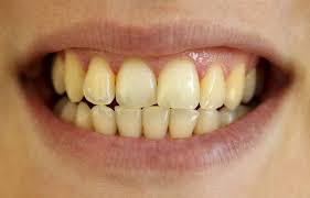 Pin On Dental Concerns