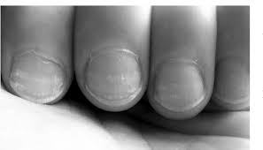 Image result for Muehrcke Line