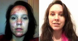 Rosacea: Why are cases rising and what is it like to suffer with it?