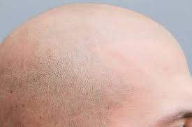 Bei der fue ( f ollicular u nit e xtraction) haartransplantation handelt es sich um eine sehr schonende methode der haartransplantation, ohne skalpell, ohne naht, und ohne lange narben. Mikrohaarpigmentierung Alternative Zur Haartransplantation