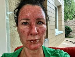 Discover the causes, types, and treatments of skin cancer. Real Life Mermaid Who Lay On Foil To Boost Tan Gets Skin Cancer After Ditching Sun Cream To Not Break The Illusion