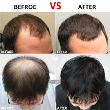 Hair Regrowth Micro Needling Roller Beard Growth Product Anti Hair Loss Review Herbal Hair Growth Hair Loss Treatment Anti Hair Loss