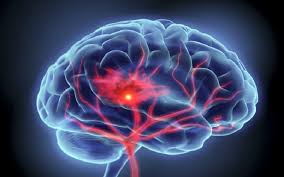 L'apport en oxygène et en nutriments est stoppé, ce qui endommage les tissus cérébraux. Accidentul Vascular Cerebral Cauze Simptome Cardiovartic