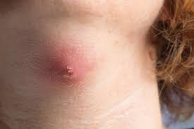 Take care of these, and keep a close eye on them. Furuncles And Carbuncles Symptoms Causes And Treatment