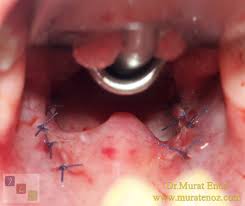 Look, if you're so concerned with cost, go down a branch of skins in your city to get a free consultation with private i went to a private dermatologist to get a mole removed. A Few Practical Recommendations To Speed Up Recovery After Tonsillectomy
