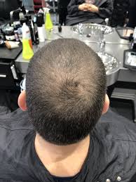 Expert and celebrity advice on thinning hair. Are You Suffering From Thinning Hair Iconic