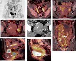 Check spelling or type a new query. Pet Ct Variants And Pitfalls In Gynecological Cancers Sciencedirect