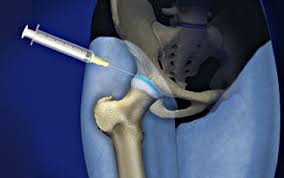 Image result for Joint Injection