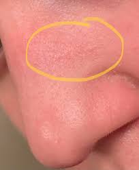 These melanoma pictures can help you determine what to look for. Does This Dry Patch Of Skin On My Nose Look Like It Could Be Skin Cancer I Don T Have It On The Other Side Skincancer