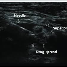 Image result for Superior Trunk Block