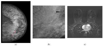 Radiological Features of B3 Lesions in Mutation Carrier Patients: A  Single-Center Retrospective Analysis